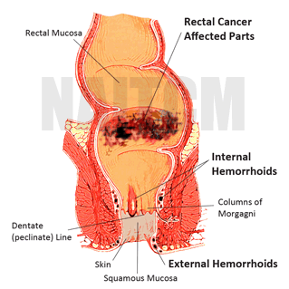 What is rectal cancer or hemorrhoids 