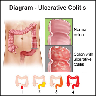 Ulcerative-Colitis_naitcm.com
