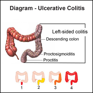 ulcerative-colitis_naitcm.com