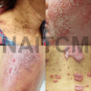 skin_disease